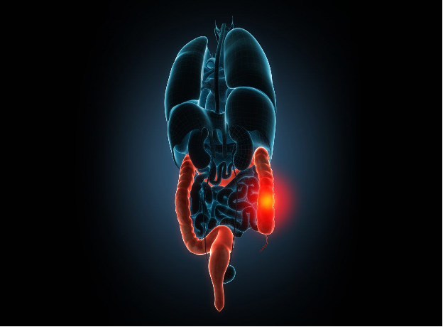 Rectal Outlet Dysfunction